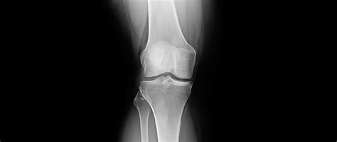 Radiografia De Rodilla Con Artrosis Actualizado Octubre 2024