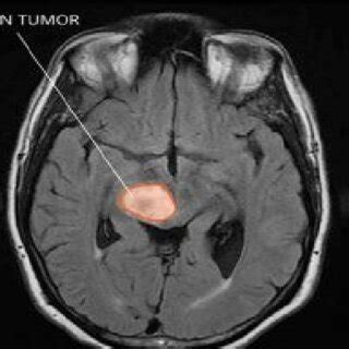 Brain Tumor MRI image [2] | Download Scientific Diagram