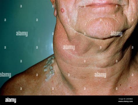 Lymphoma Clinical Photo Of The Neck Of A Patient With A Non Hodgkins Type Lymphoma A Cancer