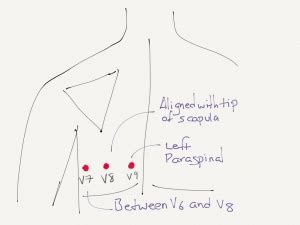 Posterior ECG Lead Placement | Resus Review