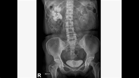 衛教投影片經皮氣球擴張腎臟造瘻取石手術 Percutaneous nephrolithotomy PCNL YouTube