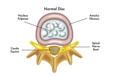 L4 L5 Disc Bulge Treatment Without Surgery In Chennai - Bios Pics