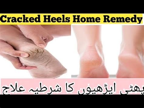 Crack Heel Home Remedy Remove Creack Heels Get Beautiful Feet