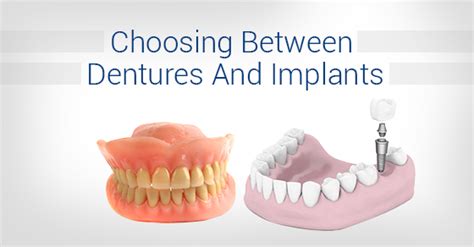 Tooth Replacement Choosing Between Dental Implants And Dentures