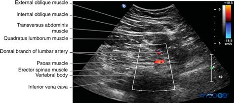 regional-anesthesia-color-doppler-image-of-lumbar-paravertebral-region ...