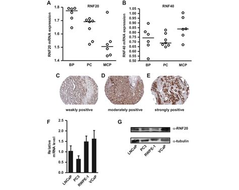 Expression Of Rnf20 In Prostate Cancer Specimens And Cultured Prostate