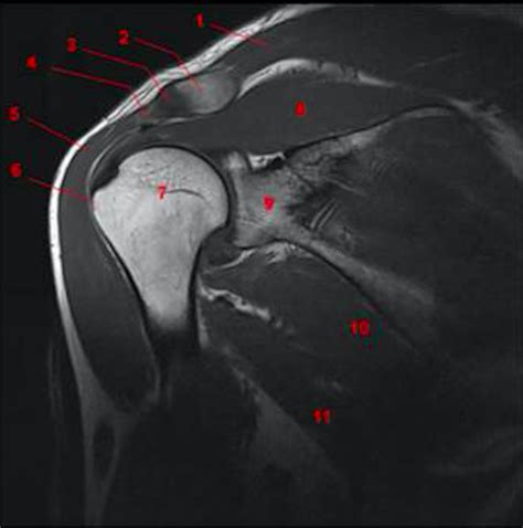 Shoulder Mri Photo Diagram Quizlet