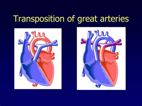 Approach To Cyanotic Congenital Heart Disease Ppt