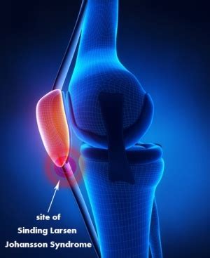 Sinding Larsen Johansson Syndrome - Physiopedia