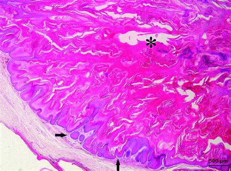 Histological Section Of A Keratoacanthoma From The Skin Of The Body