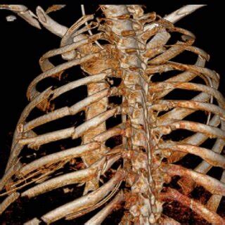 Postoperative D Reconstruction Of Ct Scan At Year Follow Up