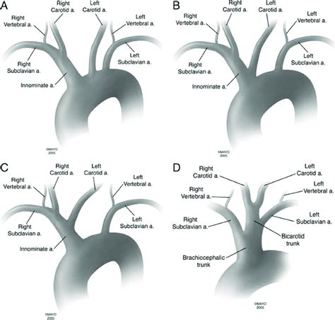 Aortic Arch Types Panel A The Most Common Aortic Arch Branching