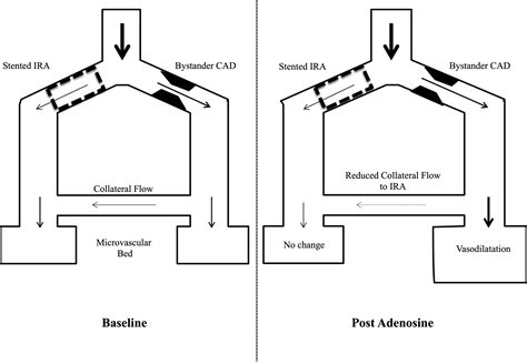 Adenosineinduced Coronary Steal Is Observed In Patients Presenting