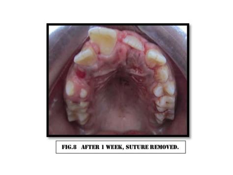 Surgical extraction of supernumerary tooth