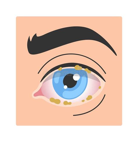 Blepharitis Human Eye Disease Stock Vector - Illustration of eyeball ...