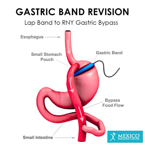 Lap Band Revision Surgery In Mexico Mexico Bariatric Center