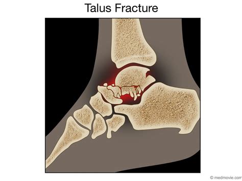 Talus Fracture In The Foot