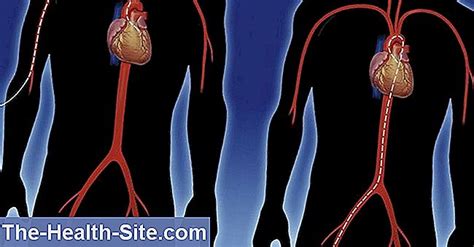 cardiac catheterization definition reasons procedure scientific
