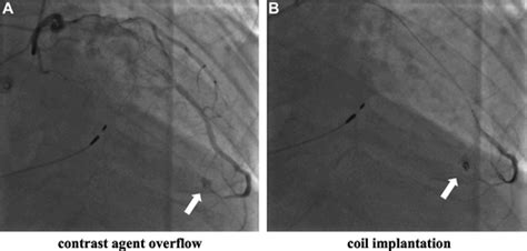 Interventricular Septal Hematoma With Pericardial Effusion After Left