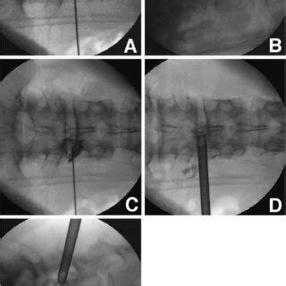 Anteroposterior Fluoroscopic Image A Showing The Final Target Point