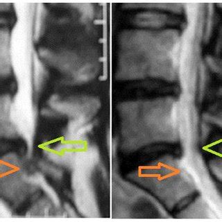 Axial MRI images showing postero-lateral L5-S1 disc protrusion which... | Download High-Quality ...