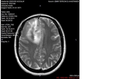 Remote Cerebellar Hemorrhage After Frontal Lobectomy Zebra Sign