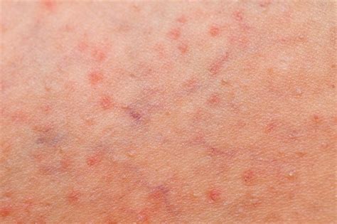 What is folliculitis and how is it treated?