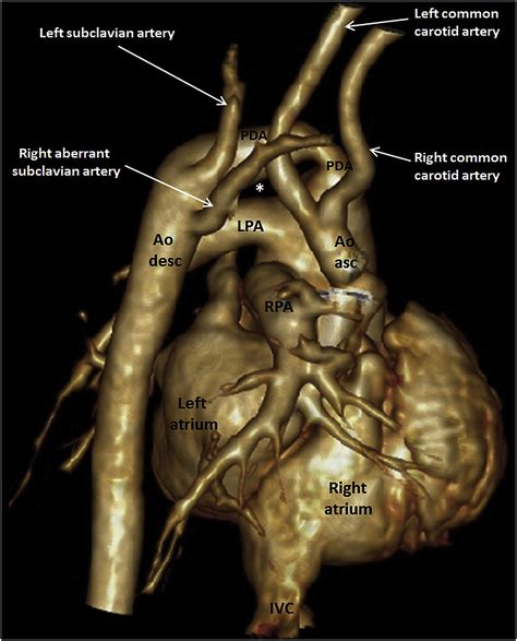 Truncus Arteriosus Communis Associated With Interrupted Aortic Arch