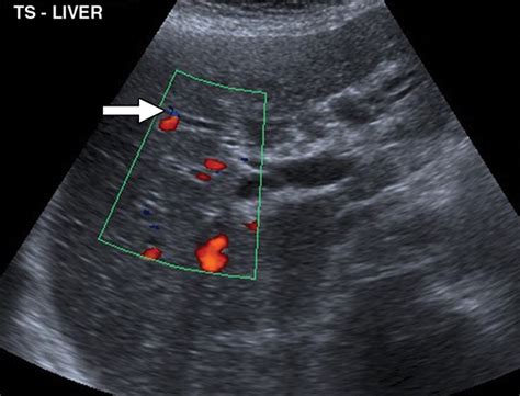 Imaging Of Biliary Tract Disease Ajr