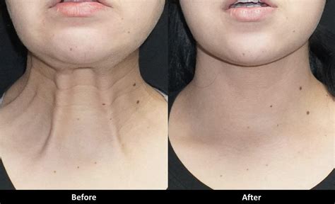 Botox Can Treat Wrinkles And Bands On The Neck