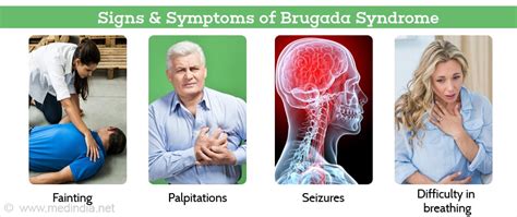 Brugada Syndrome Causes Symptoms Diagnosis Treatment