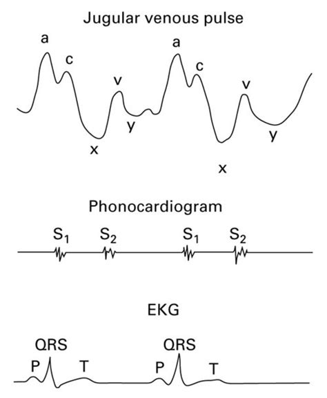 Jugular Venous Pressure Waveforms