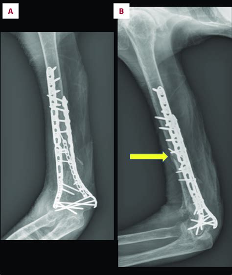 Anterior Posterior A And Lateral B Radiographs Taken At 3 Month