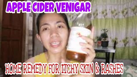 Apple Cider Vinegar Remedy For Itchy Skin And Rashes By Maricel Atad Youtube