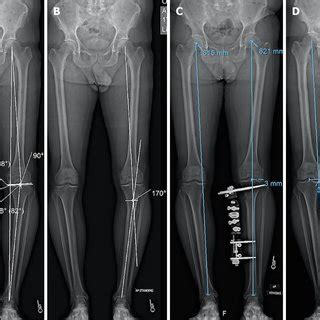 High Tibial Osteotomy With External Fixator A And B Before Correction