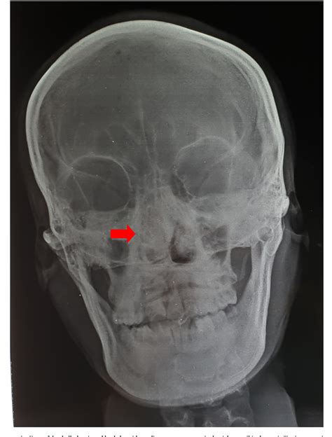 Figure 1 From Combined Transcranial And Transnasal Endoscopic Approach