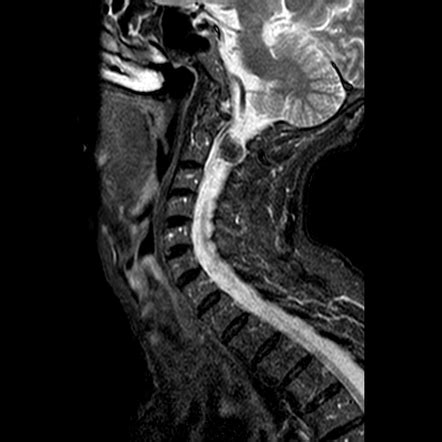 Spinal Meningioma Cervical Radiology Case Radiopaedia Org