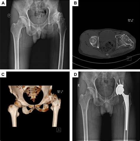 Conversion Total Hip Arthroplasty After Pedicled Peri Hip Bone Flap