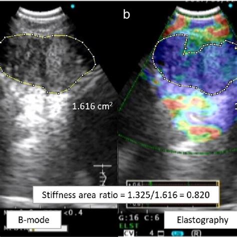 Quantitative Evaluation Of Endobronchial Ultrasound Ebus Elastography