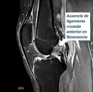 Lesion Ligamento Cruzado Anterior Traumatologo En Madrid Juan Arnal