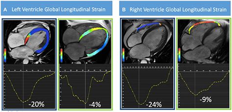 Frontiers Prognostic Significance Of Feature Tracking Right