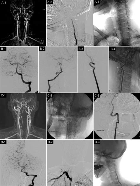 Rotational Vertebral Artery Occlusion Stroke