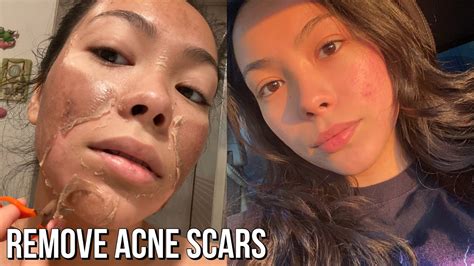 Acne Scars Before And After Chemical Peel