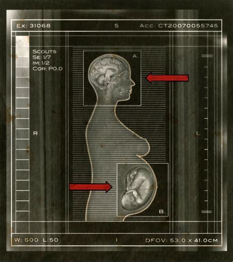 The Headache That Wouldn’t Go Away - The New York Times