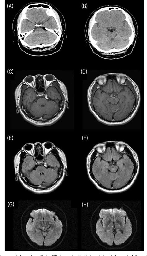 Figure 1 From Cerebral Infarction Following Rupture Of Intracranial