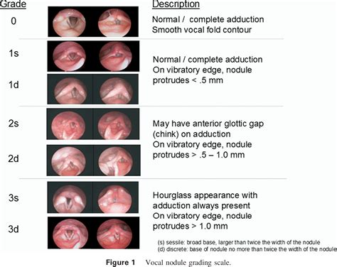 Figure 1 From A Grading Scale For Pediatric Vocal Fold Nodules