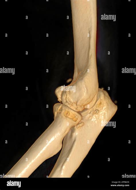 Ct Scan Of Elbow Joint 3d Rendering Stock Photo Alamy