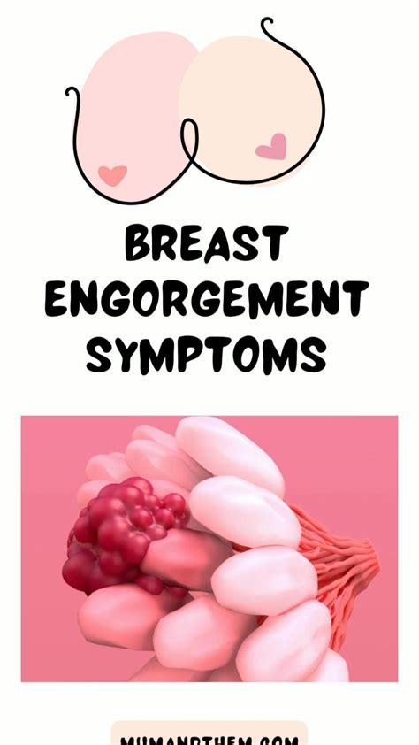 Breast Engorgement Symptoms How To Cure Breast Engorgement Artofit