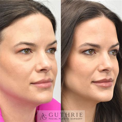 Lower Blepharoplasty Real Patient Before After Guthrie Facial