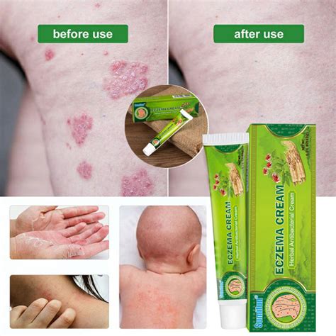 Ubat Gatal Kulit Psoriasis Cream Ubat Gatal Herba Cina Antifungal Cream